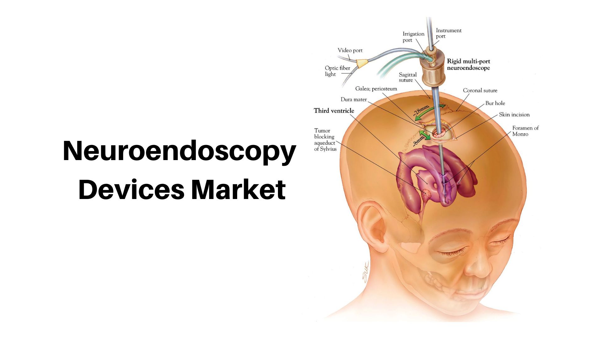 Neuroendoscopy Devices Market to Cross USD 326 Mn in 2033 | 5.30% CAGR