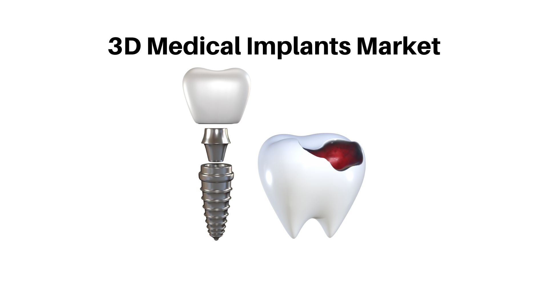 3D Medical Implants Market Size USD 8.8 bn | Vendors Analysis (Ingenico, Verifone) By 2032