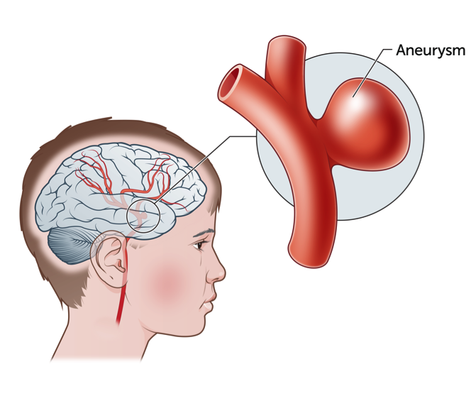 Intracranial Aneurysm Market Sales to Top USD 2.7 Billion in Revenues by 2033 at a CAGR of 8.8%
