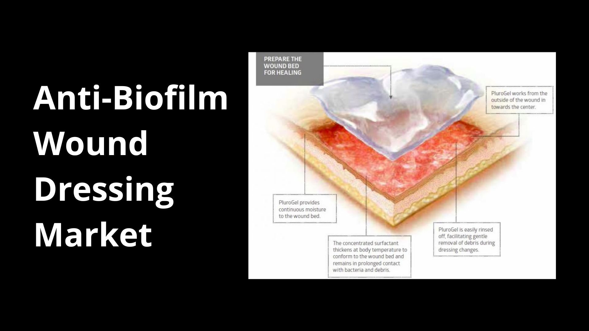 Anti-Biofilm Wound Dressing Market Sales to Top USD 1,799 Million in 2032 at a CAGR of close to 9.7%, says Market.us
